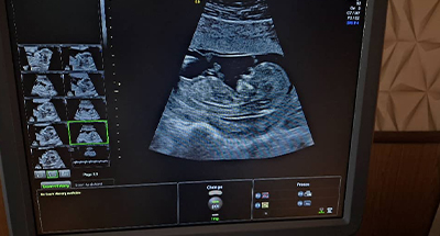 سونوگرافی بارداری