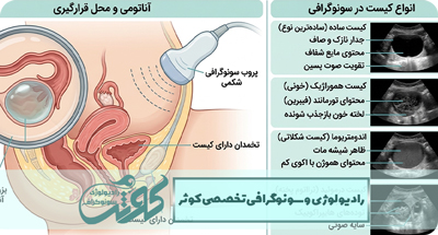 کیست تخمدان چگونه در سونوگرافی تشخیص داده می‌شود؟ راهنمای کامل علائم، انواع و درمان